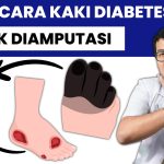Waspada Kaki Diabetes, 18,6 Juta Orang Terkena Setiap Tahun